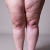 Lipedema e linfedema